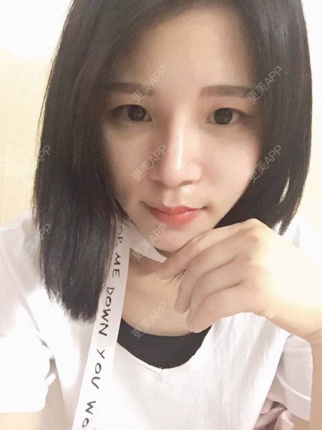 更美 - 本是完美的妞😄的鼻部多项经验 | 广州 | 全自体耳软骨隆鼻 | 眼部整形 | 鼻部多项