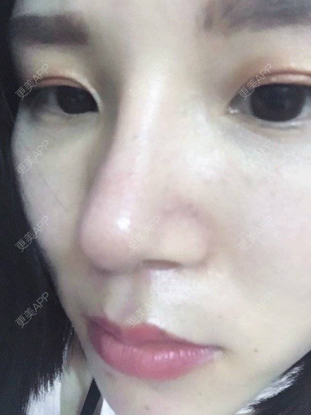 更美 - 本是完美的妞😄的鼻部多项经验 | 广州 | 全自体耳软骨隆鼻 | 眼部整形 | 鼻部多项
