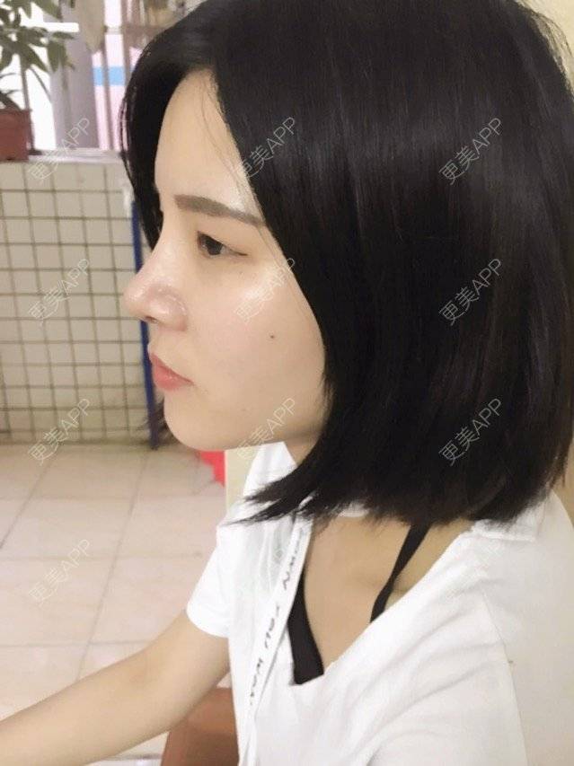 更美 - 本是完美的妞😄的鼻部多项经验 | 广州 | 全自体耳软骨隆鼻 | 眼部整形 | 鼻部多项