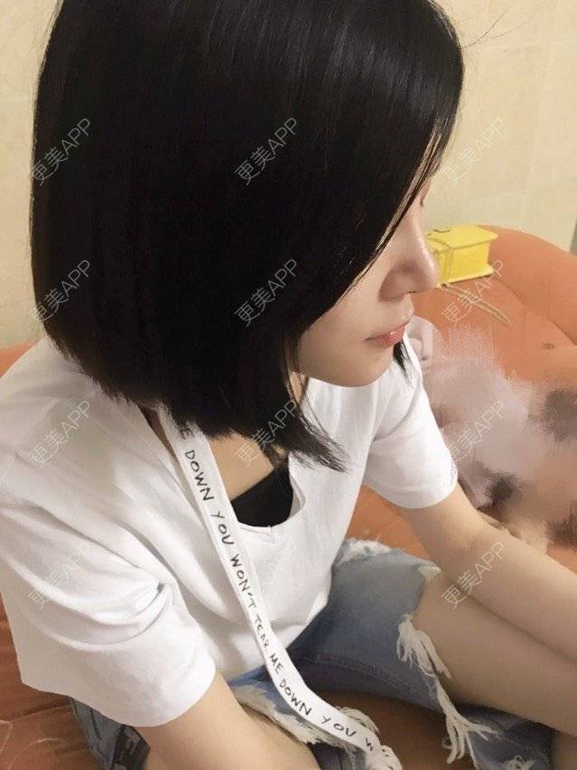 更美 - 本是完美的妞😄的鼻部多项经验 | 广州 | 全自体耳软骨隆鼻 | 眼部整形 | 鼻部多项