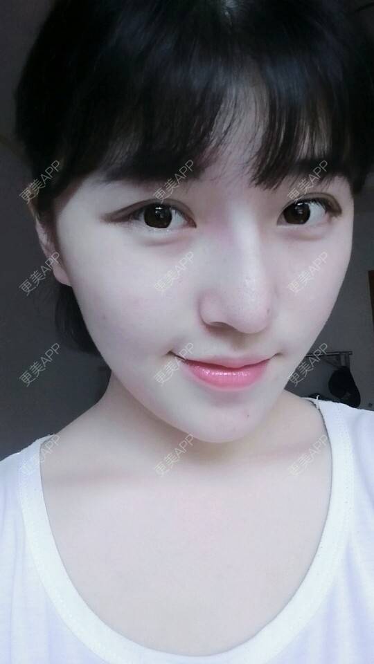 更美 - 汽水的味道的自体脂肪丰苹果肌经验 | 自体脂肪丰苹果肌 | 面吸双下巴 | 下面部吸脂 | 自体脂肪面部年轻化 | 成都 | 视频日记