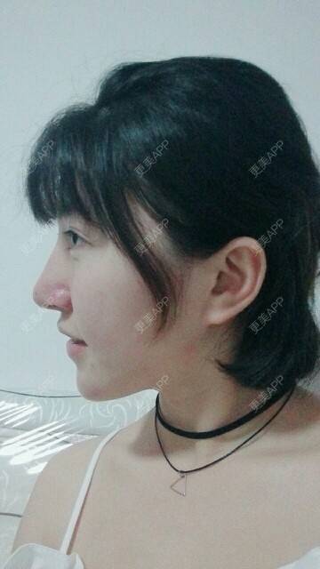 更美 - 汽水的味道的自体脂肪丰苹果肌经验 | 自体脂肪丰苹果肌 | 面吸双下巴 | 下面部吸脂 | 自体脂肪面部年轻化 | 成都 | 视频日记