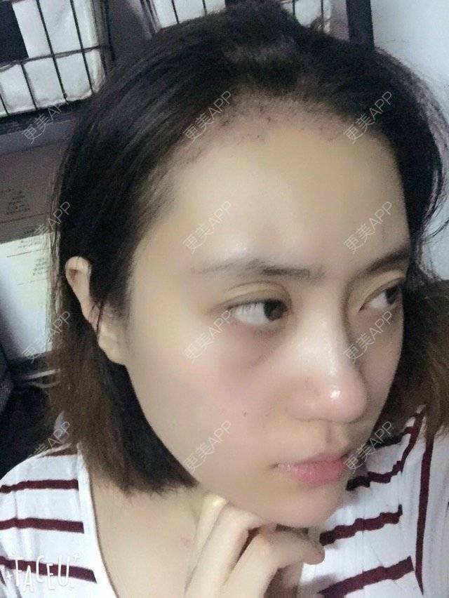 咸阳植发专家视频(西安植发的三甲医院)