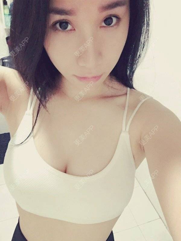 更美 - 小米max的自体脂肪隆胸经验 | 自体脂肪隆胸 | 丰胸（隆胸） | 隆胸 | 重庆