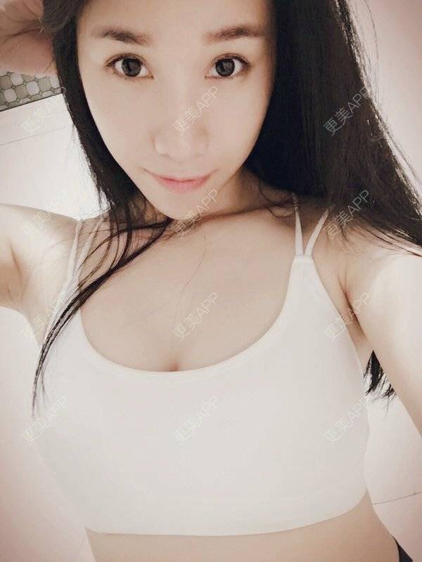 更美 - 小米max的自体脂肪隆胸经验 | 自体脂肪隆胸 | 丰胸（隆胸） | 隆胸 | 重庆