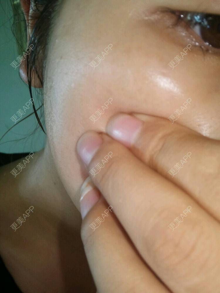更美 - 更美用户lUumlTUoyX的经验 | 祛斑祛色素 | 西安