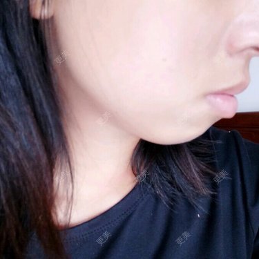硅胶下巴