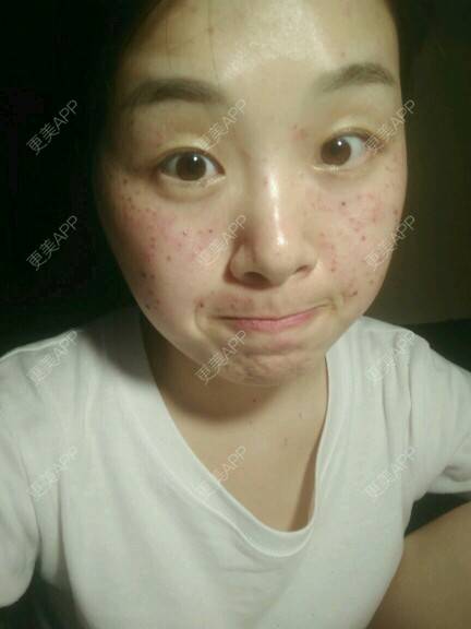 更美 - 艳艳小芒果的激光淡斑经验 | 激光淡斑 | 激光雀斑 | 长沙 | 雀斑