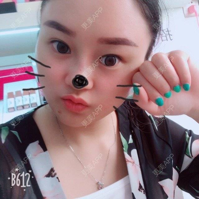 更美 - 更美用户LXBe7XUMWQ的玻尿酸鼻部经验 | 成都 | 玻尿酸鼻部 | 瘦脸类