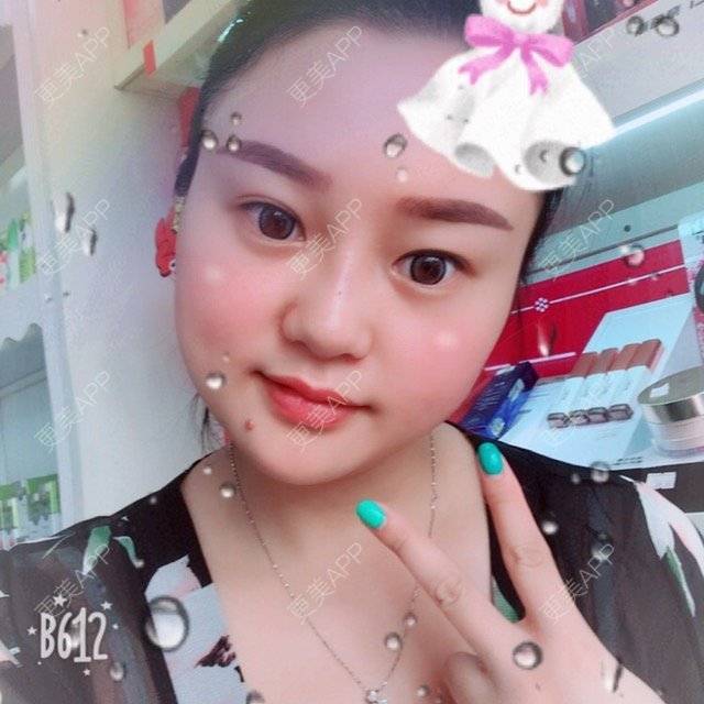 更美 - 更美用户LXBe7XUMWQ的玻尿酸鼻部经验 | 成都 | 玻尿酸鼻部 | 瘦脸类
