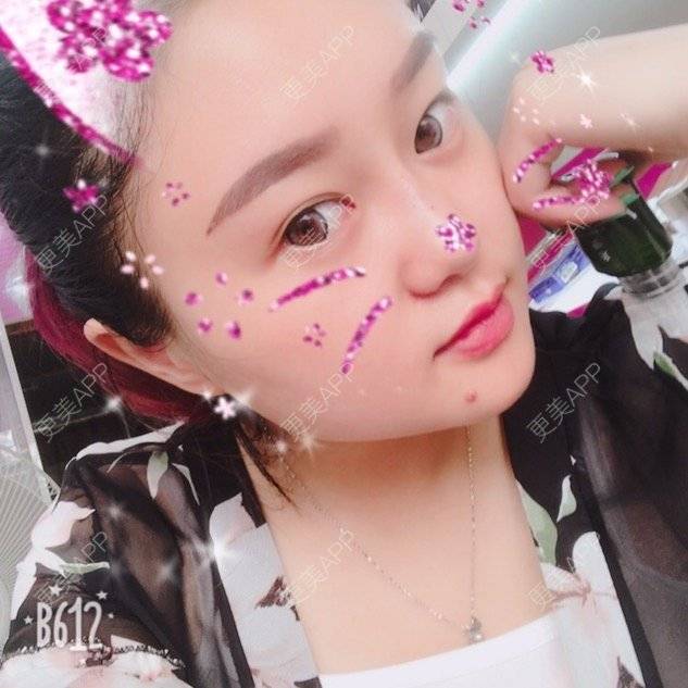 更美 - 更美用户LXBe7XUMWQ的玻尿酸鼻部经验 | 成都 | 玻尿酸鼻部 | 瘦脸类