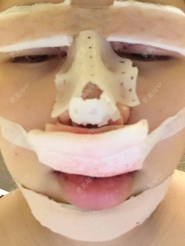 更美 - 竹攸的全脸整形套餐经验 | 广州 | 全脸整形套餐 | 进口瘦脸针 | 鼻部多项