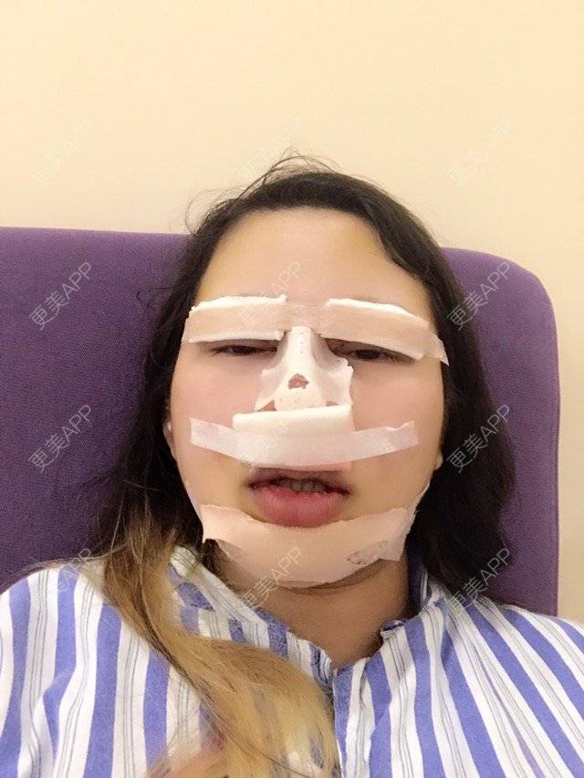 更美 - 竹攸的全脸整形套餐经验 | 广州 | 全脸整形套餐 | 进口瘦脸针 | 鼻部多项