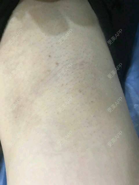 更美 - 更美用户kNZTUxA9fD的激光脱腋毛经验 | 激光脱腋毛 | 激光脱毛 | 激光脱毛腋下 | 长沙