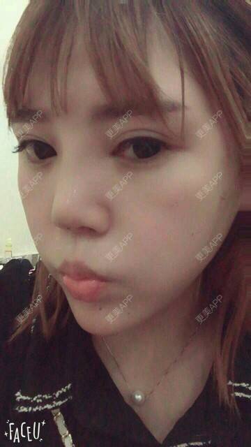 更美 - BabyfaceTT的埋线隆鼻经验 | 长沙 | 埋线隆鼻 | 注射隆鼻