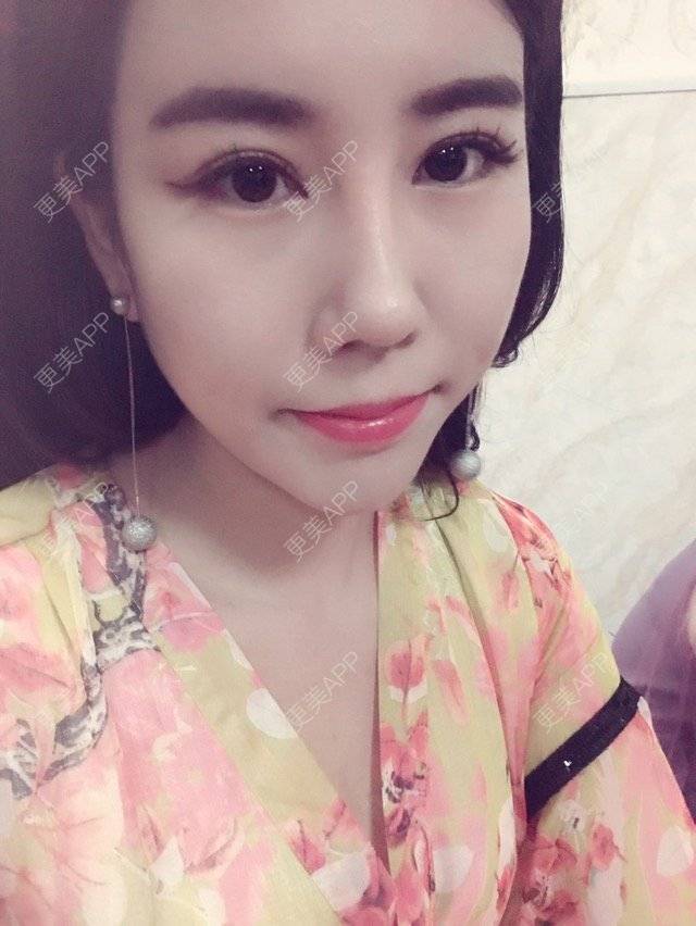 更美 - 更美用户YdB0Dcw3Me的肋软骨隆鼻经验 | 肋软骨隆鼻 | 威海