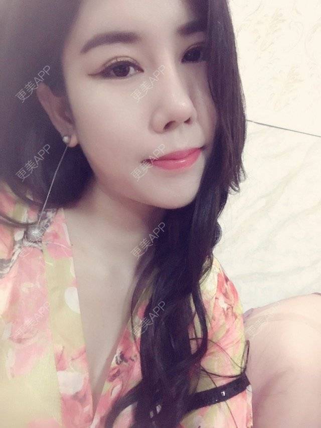 更美 - 更美用户YdB0Dcw3Me的肋软骨隆鼻经验 | 肋软骨隆鼻 | 威海