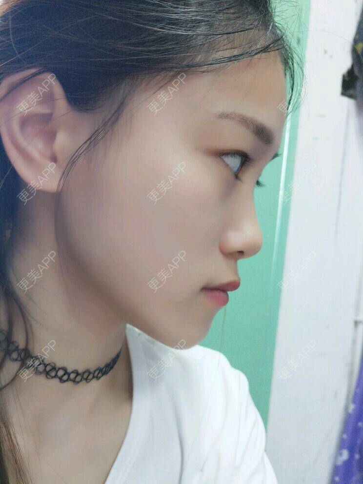 更美 - 更美用户vweUGm53qh的经验 | 晒侧颜 | 面部轮廓 | 口腔齿科 | 成都