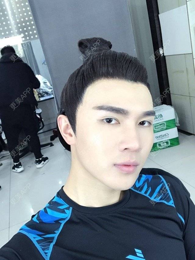 更美 - 笑笑笑水阁的玻尿酸额头经验 | 玻尿酸额头 | 长沙