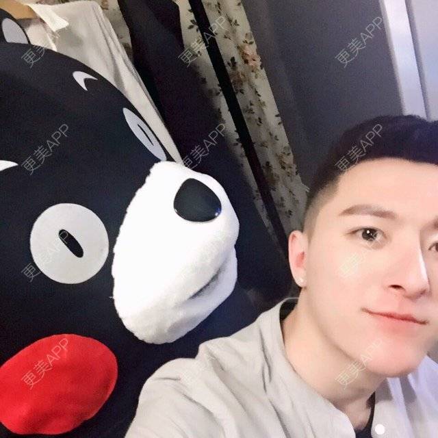 更美 - 柳安花明又一村的玻尿酸额头经验 | 长沙 | 玻尿酸额头