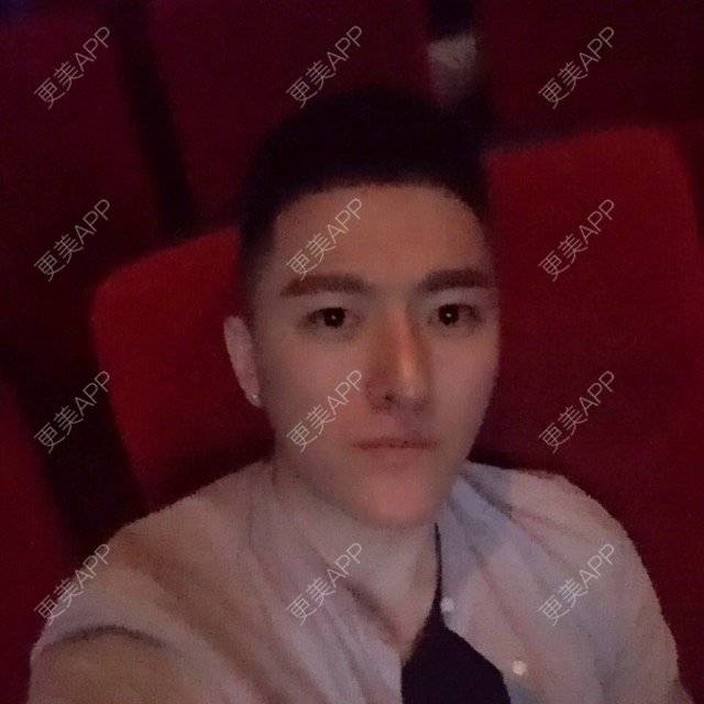 更美 - 柳安花明又一村的玻尿酸额头经验 | 长沙 | 玻尿酸额头