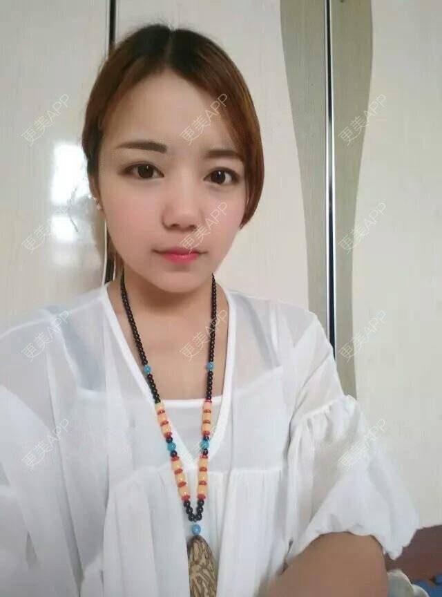 更美 - 石畔的双眼皮经验 | 美颜臣 | 双眼皮 | 眼皮吸脂 | 重庆