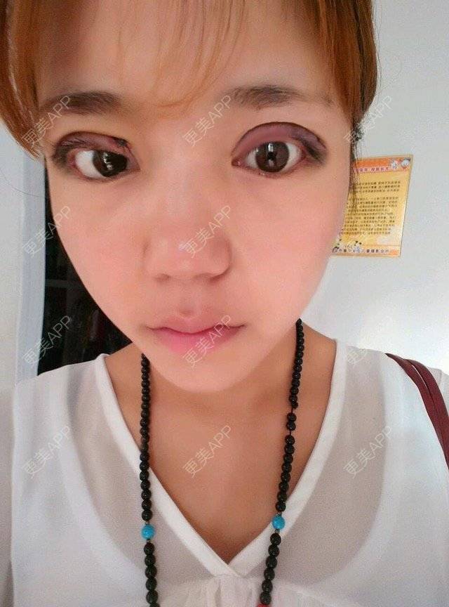 更美 - 石畔的双眼皮经验 | 美颜臣 | 双眼皮 | 眼皮吸脂 | 重庆