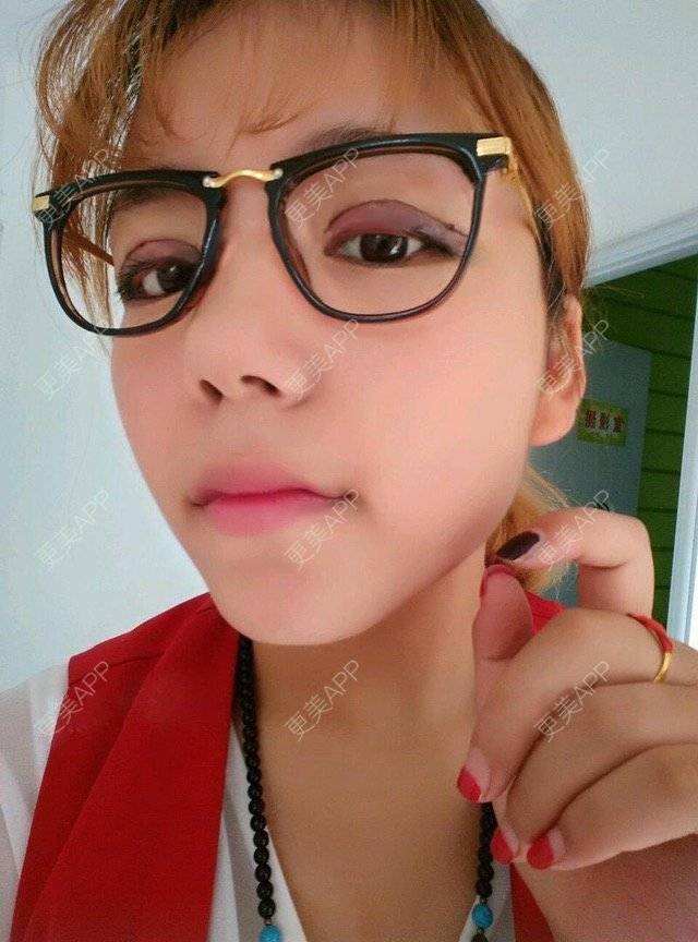 更美 - 石畔的双眼皮经验 | 美颜臣 | 双眼皮 | 眼皮吸脂 | 重庆