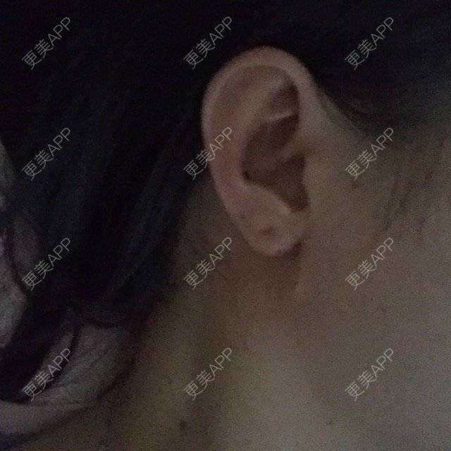 更美 - 更美用户3732664183的丰耳垂经验 | 成都 | 丰耳垂