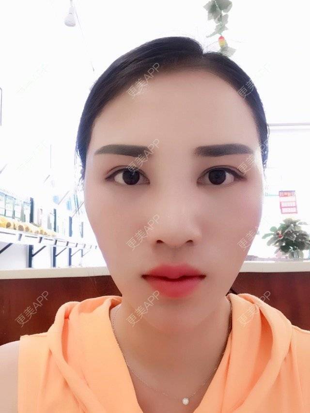 更美 - 小棉袄cc升级日记的玻尿酸下巴经验 | M唇成形 | 面部线雕 | 北京 | Misko埋线隆鼻手术 | 除皱瘦脸 | 厚唇改薄 | 玻尿酸苹果肌 | 玻尿酸下巴 | 线雕v脸成型