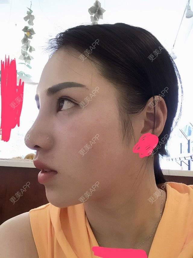更美 - 小棉袄cc升级日记的玻尿酸下巴经验 | M唇成形 | 面部线雕 | 北京 | Misko埋线隆鼻手术 | 除皱瘦脸 | 厚唇改薄 | 玻尿酸苹果肌 | 玻尿酸下巴 | 线雕v脸成型