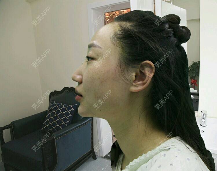 更美 - 洪梁健 医生的膨体垫下巴经验 | 膨体垫下巴 | 重庆