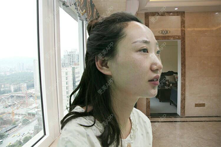 更美 - 洪梁健 医生的膨体垫下巴经验 | 膨体垫下巴 | 重庆