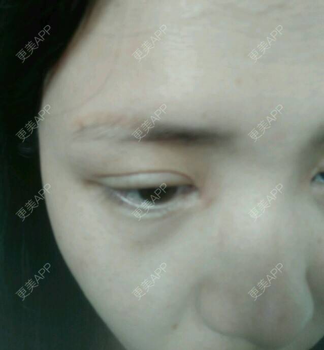 更美 - 数得清的星星的经验 | 内开眼角 | 双眼皮 | 开眼角 | 成都