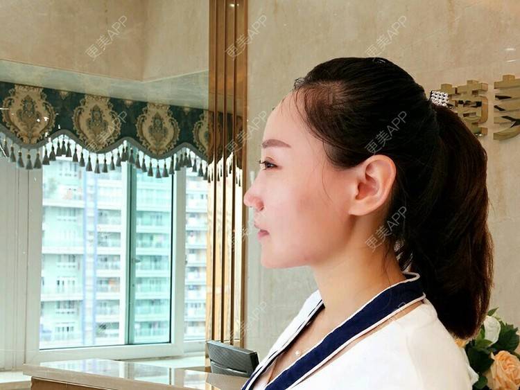 更美 - 洪梁健 医生的膨体垫下巴经验 | 膨体垫下巴 | 重庆