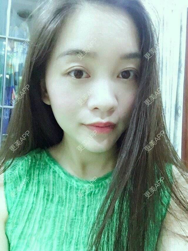 更美 - 彩小文的除皱瘦脸经验 | 瘦脸除皱 | 注射瘦脸· | 除皱瘦脸 | 北京