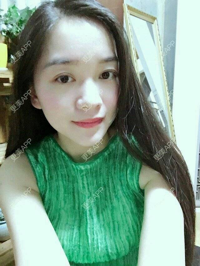 更美 - 彩小文的除皱瘦脸经验 | 瘦脸除皱 | 注射瘦脸· | 除皱瘦脸 | 北京