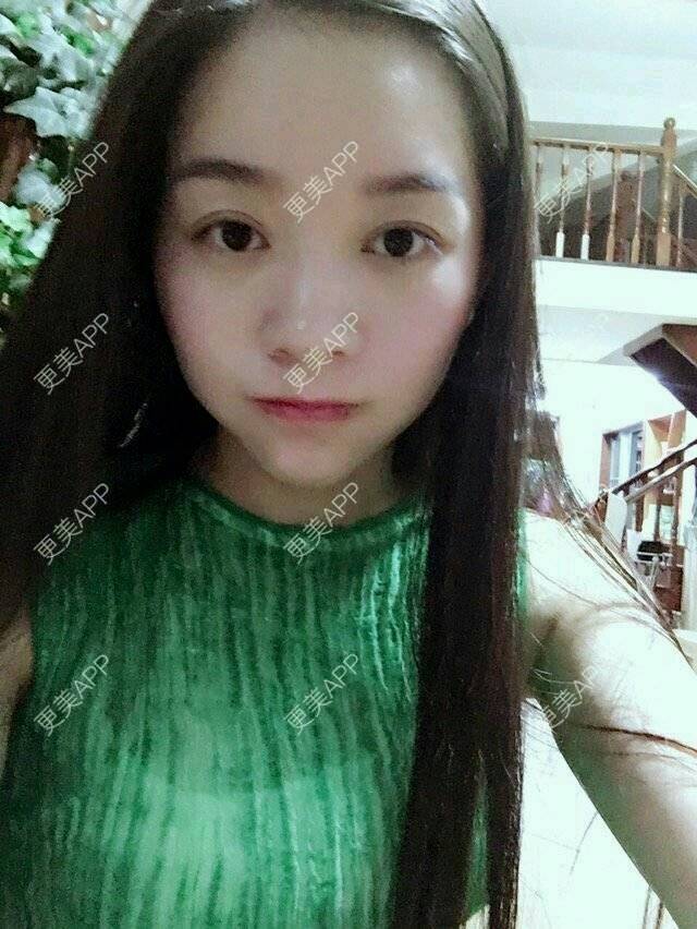 更美 - 彩小文的除皱瘦脸经验 | 瘦脸除皱 | 注射瘦脸· | 除皱瘦脸 | 北京