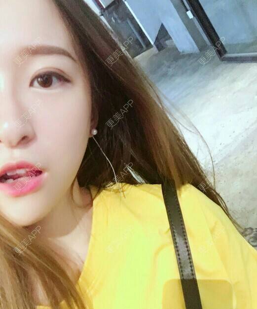 更美 - 月半小猫的淡斑套餐经验 | 淡斑套餐 | 上海