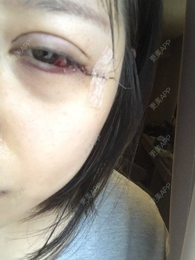 更美 - K.Bi的经验 | 线雕鼻子 | 眼睑下至 | 广州