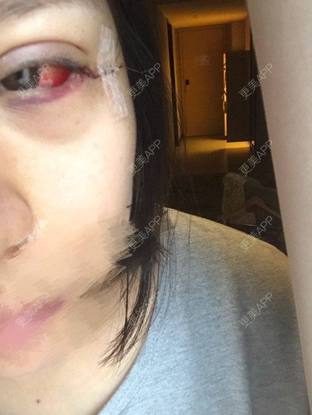 更美 - K.Bi的经验 | 线雕鼻子 | 眼睑下至 | 广州