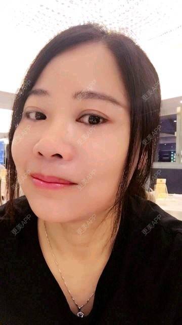 更美 - 深芩的埋线提升经验 | 埋线提升 | 面部轮廓 | 全面部提升 | 深圳