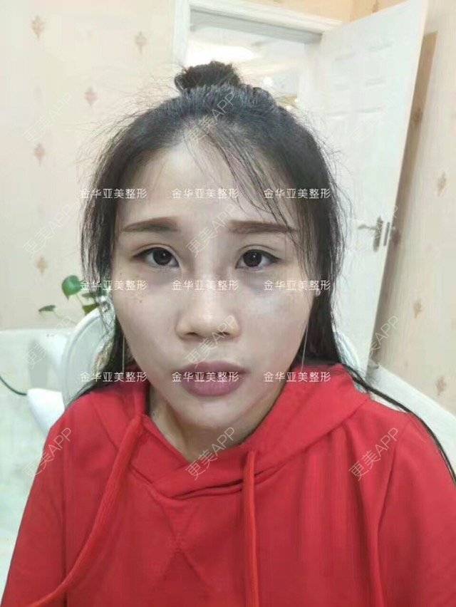 更美 - 邓泽臣 医生的膨体隆鼻经验 | 膨体隆鼻 | 鼻部整形