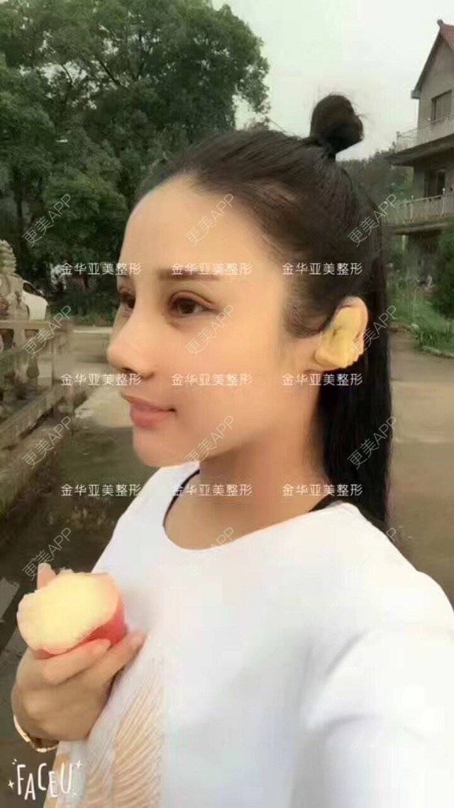 更美 - 邓泽臣 医生的膨体隆鼻经验 | 膨体隆鼻 | 鼻部整形