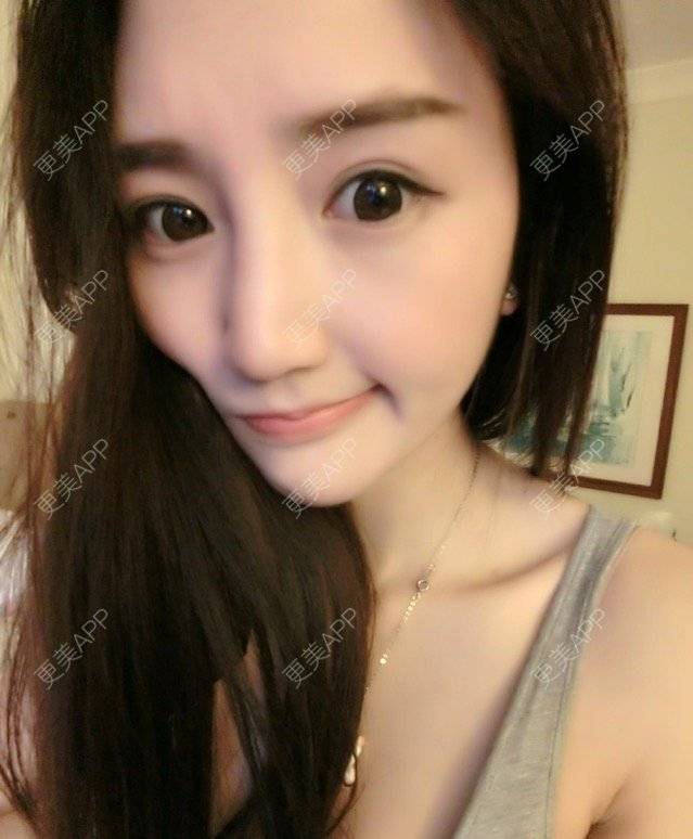 更美 - 更美用户b0X9J3zser的淡化皱纹经验 | 淡化皱纹 | 注射除皱针打鱼尾纹 | 杭州