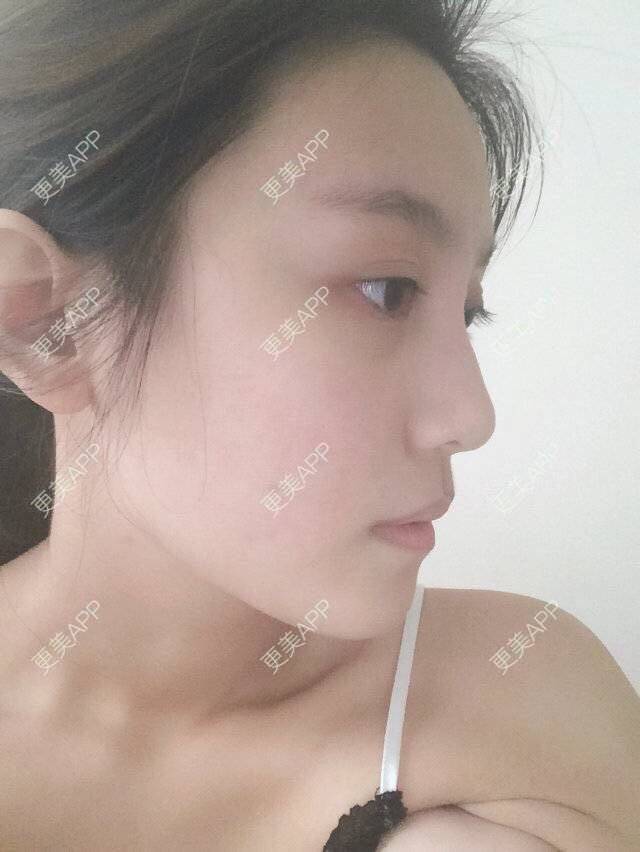 更美 - TT娜的经验 | 鼻部整形 | 鼻部多项 | 缩鼻头手术 | 济南