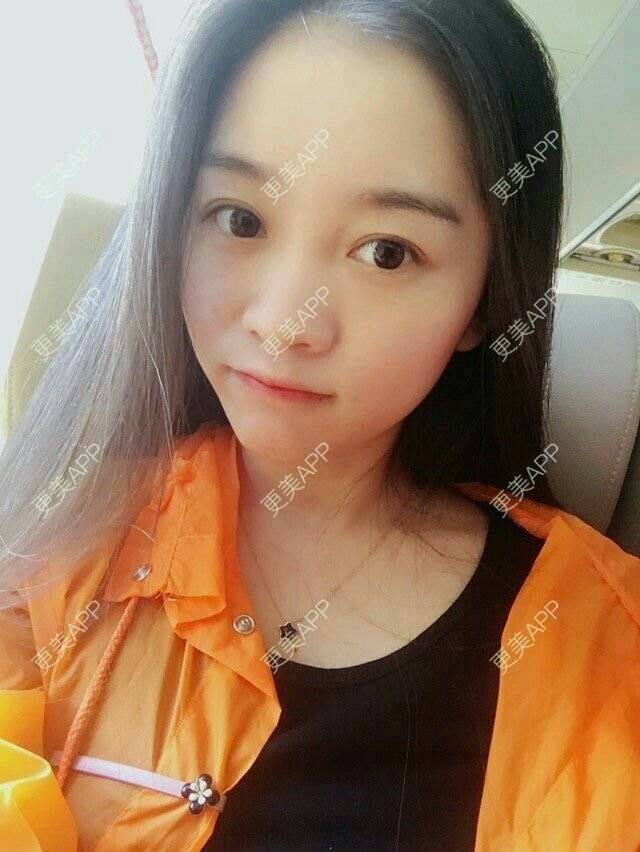 更美 - 彩小文的除皱瘦脸经验 | 注射肉毒素 | 除皱瘦脸 | 瘦脸类 | 北京