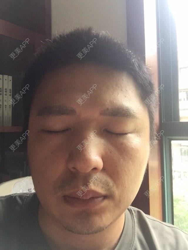 更美 - 更美用户GJ8KoO9ghr的植眉经验 | 金华 | 植眉 | 眉毛种植