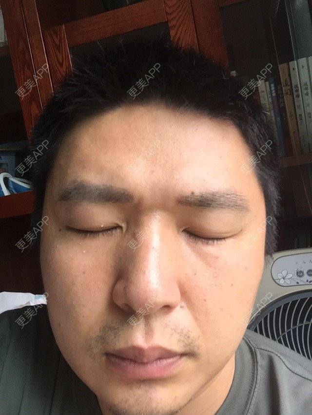 更美 - 更美用户GJ8KoO9ghr的植眉经验 | 金华 | 植眉 | 眉毛种植