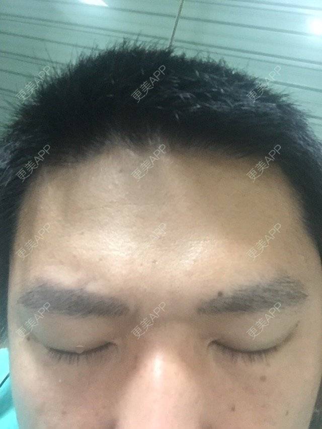 更美 - 更美用户GJ8KoO9ghr的植眉经验 | 金华 | 植眉 | 眉毛种植